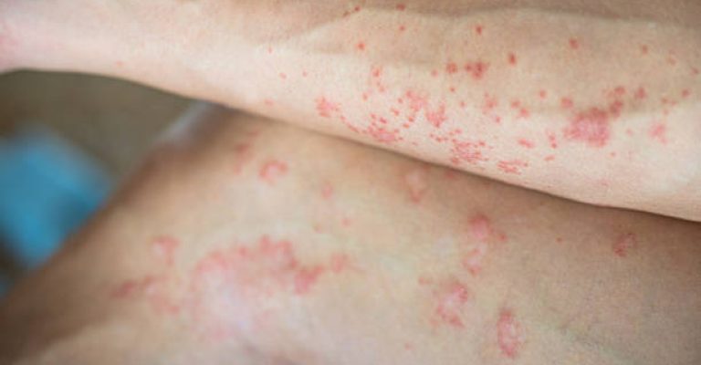 Man stress about Skin allergy problem because crisis air pollution